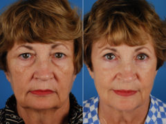 Blepharoplasty Before and After Photos in Naples, FL, Patient 10623