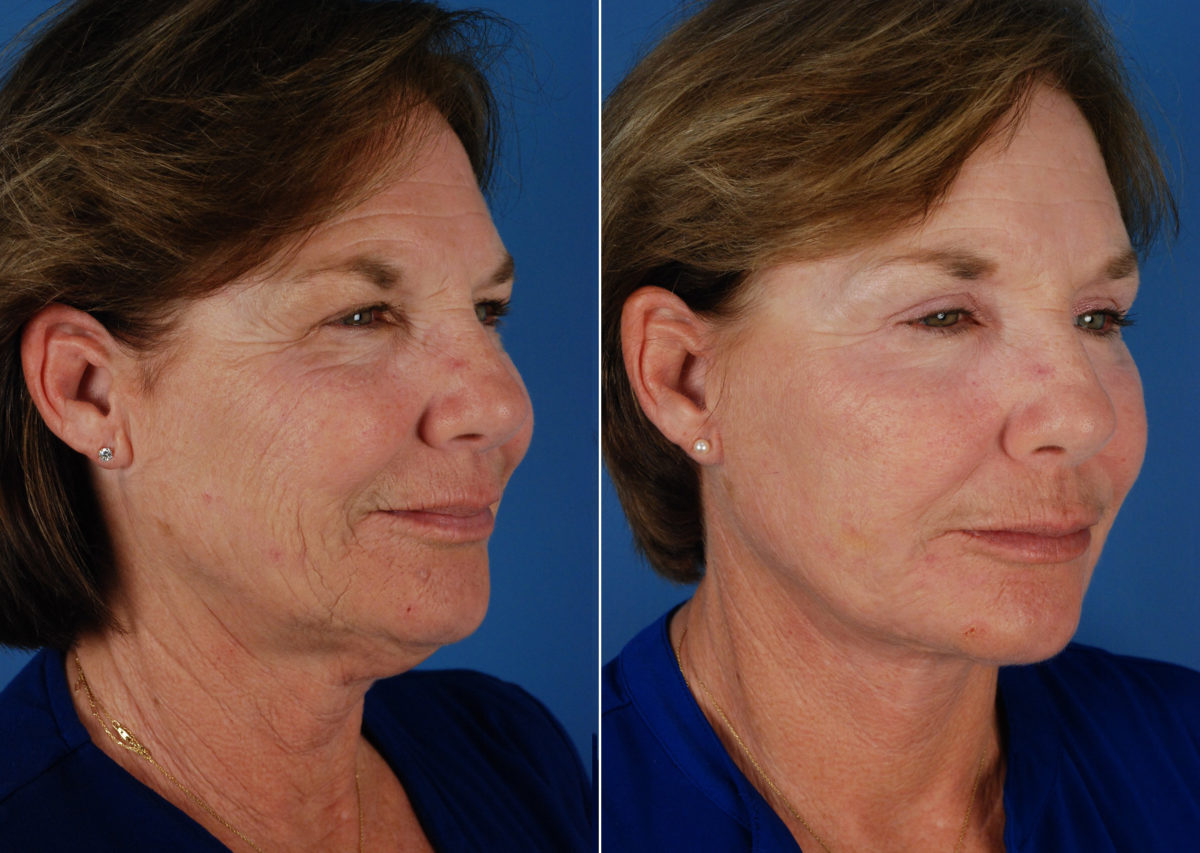 Eyebrow & Forehead Before and After Photos in Naples, FL, Patient 10653