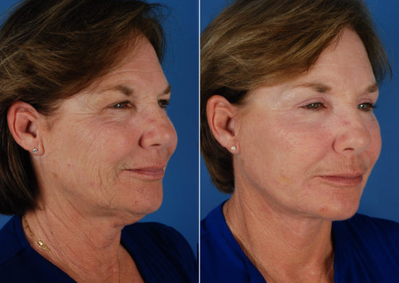 Eyebrow & Forehead Before and After Photos in Naples, FL, Patient 10653