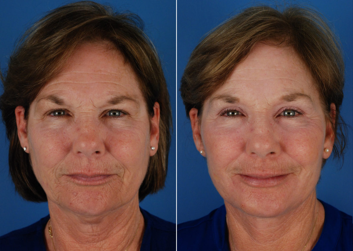 Eyebrow & Forehead Before and After Photos in Naples, FL, Patient 10653