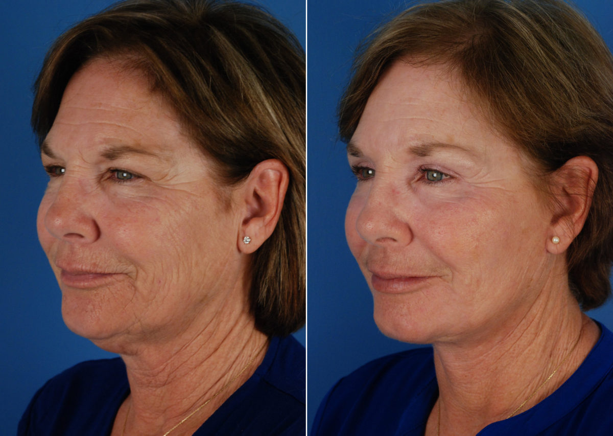 Eyebrow & Forehead Before and After Photos in Naples, FL, Patient 10653