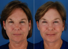 Eyebrow & Forehead Before and After Photos in Naples, FL, Patient 10653