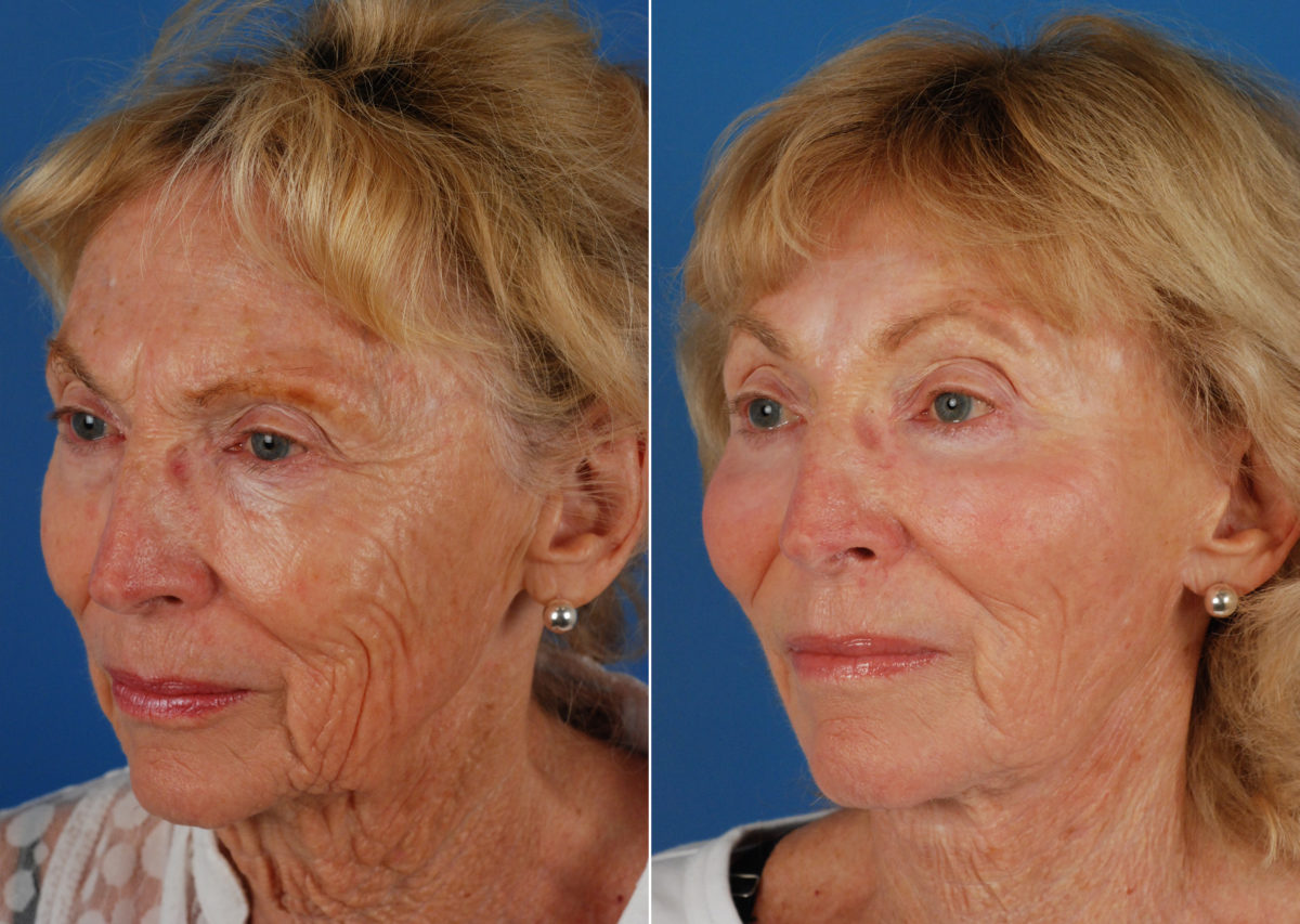 Endoscopic Facelift Before and After Photos in Naples, FL, Patient 10667