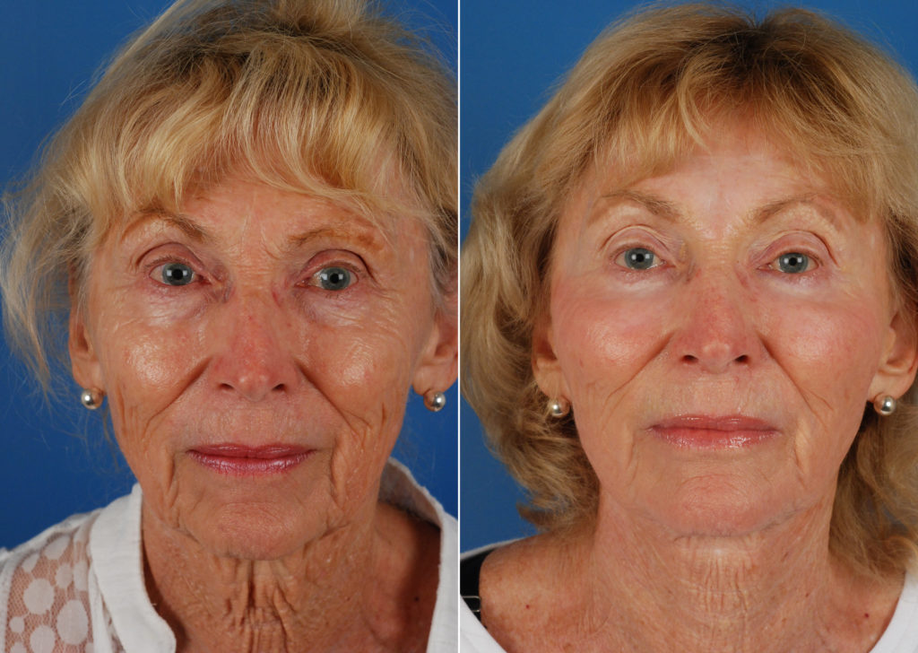 Endoscopic Facelift Photos Naples, FL Patient 10667