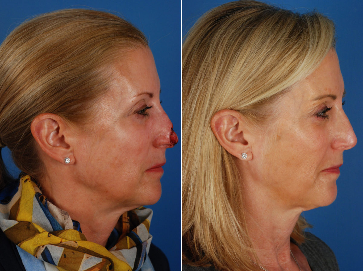 Skin Cancer Reconstruction Before and After Photos in Naples, FL, Patient 10767