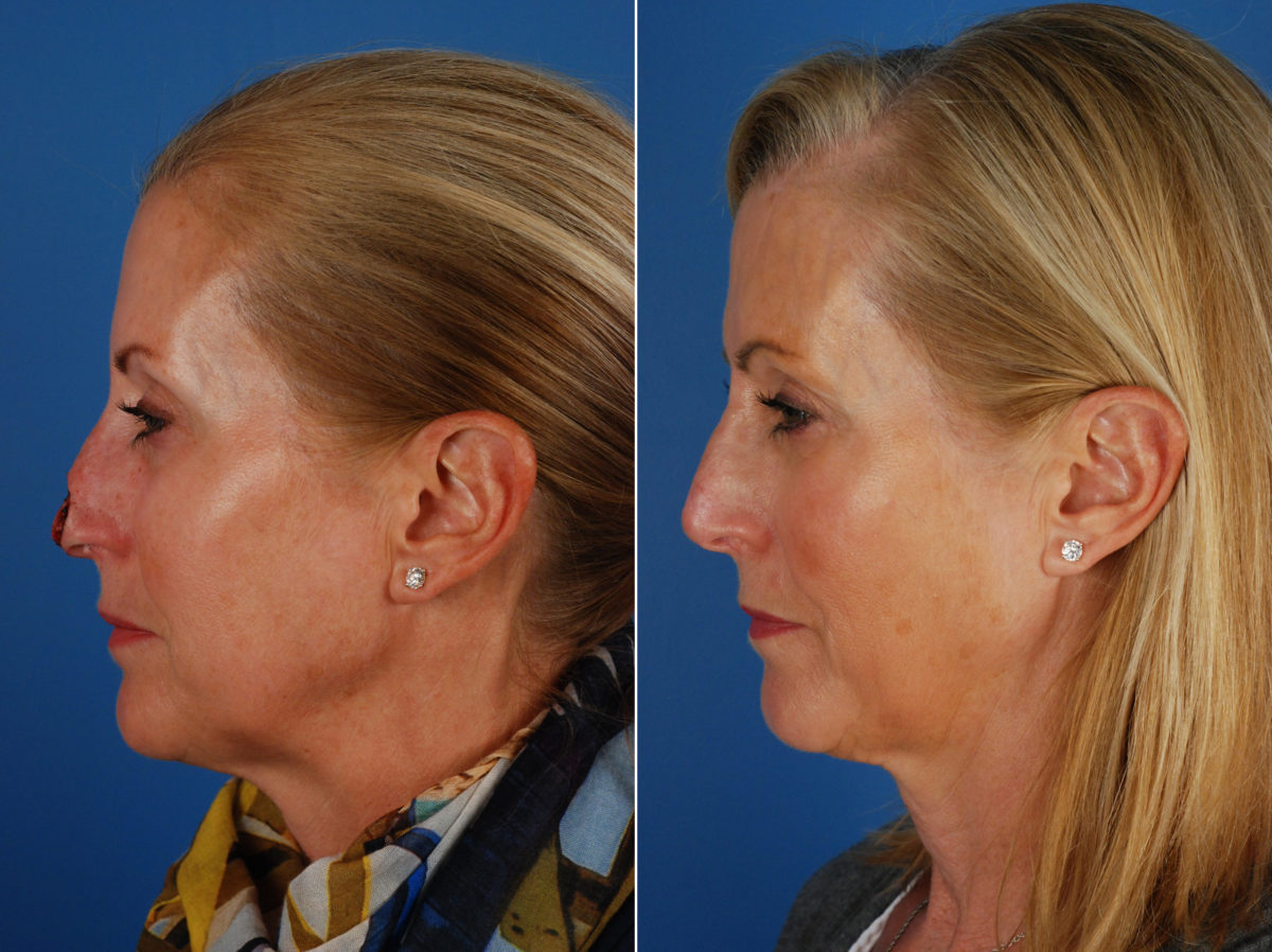 Skin Cancer Reconstruction Before and After Photos in Naples, FL, Patient 10767