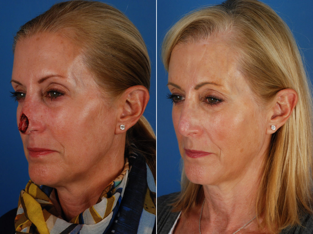 Skin Cancer Reconstruction Before and After Photos in Naples, FL, Patient 10767