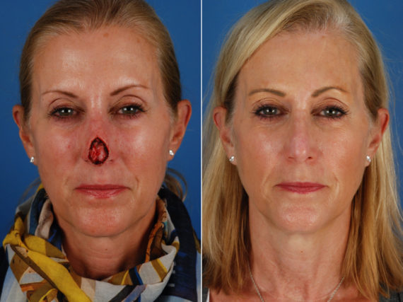 Skin Cancer Reconstruction Before and After Photos in Naples, FL, Patient 10767