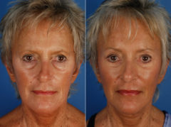 Eyebrow & Forehead Before and After Photos in Naples, FL, Patient 10926