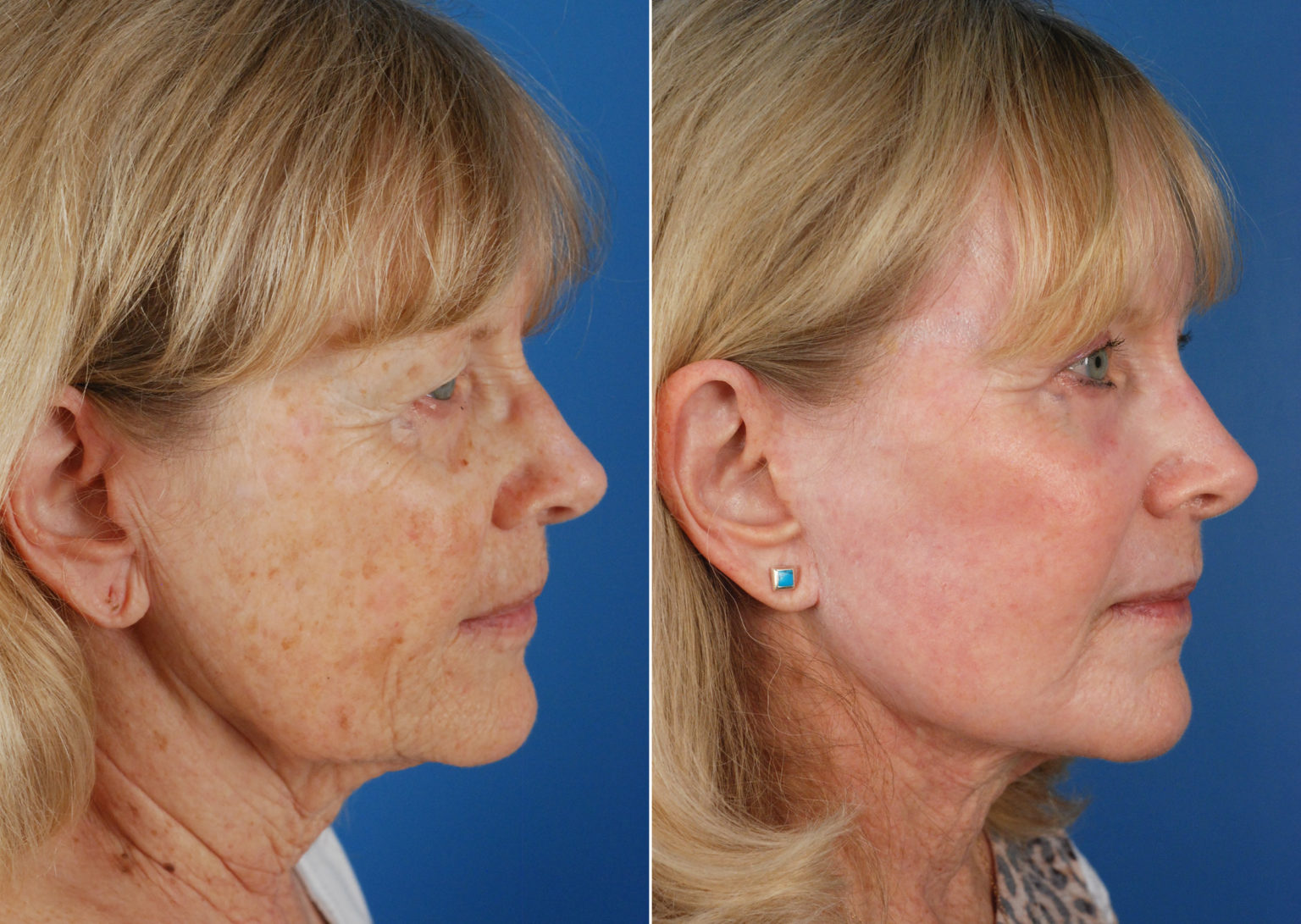 Endoscopic Facelift Photos Naples, FL Patient 10967