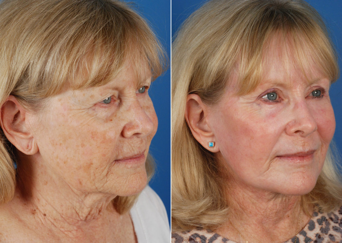 CO2 Laserwash Before and After Photos in Naples, FL, Patient 10980