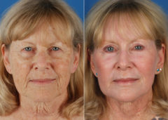 CO2 Laserwash Before and After Photos in Naples, FL, Patient 10980