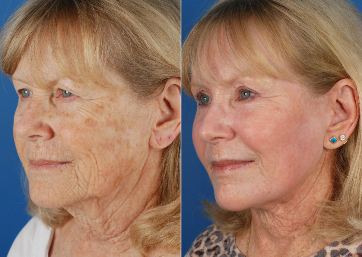 CO2 Laserwash Before and After Photos in Naples, FL, Patient 10980