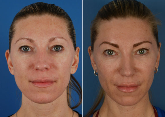 Rhinoplasty Before and After Photos in Naples, FL, Patient 11298