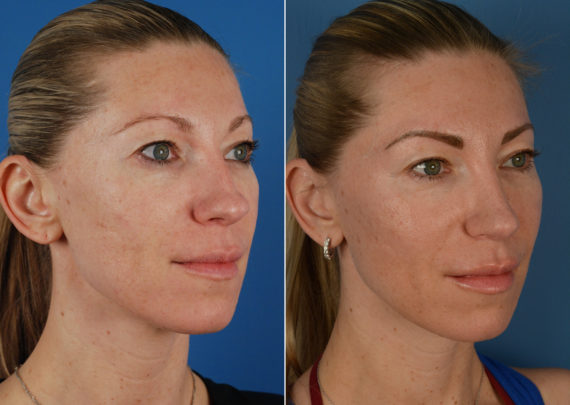 Rhinoplasty Before and After Photos in Naples, FL, Patient 11298