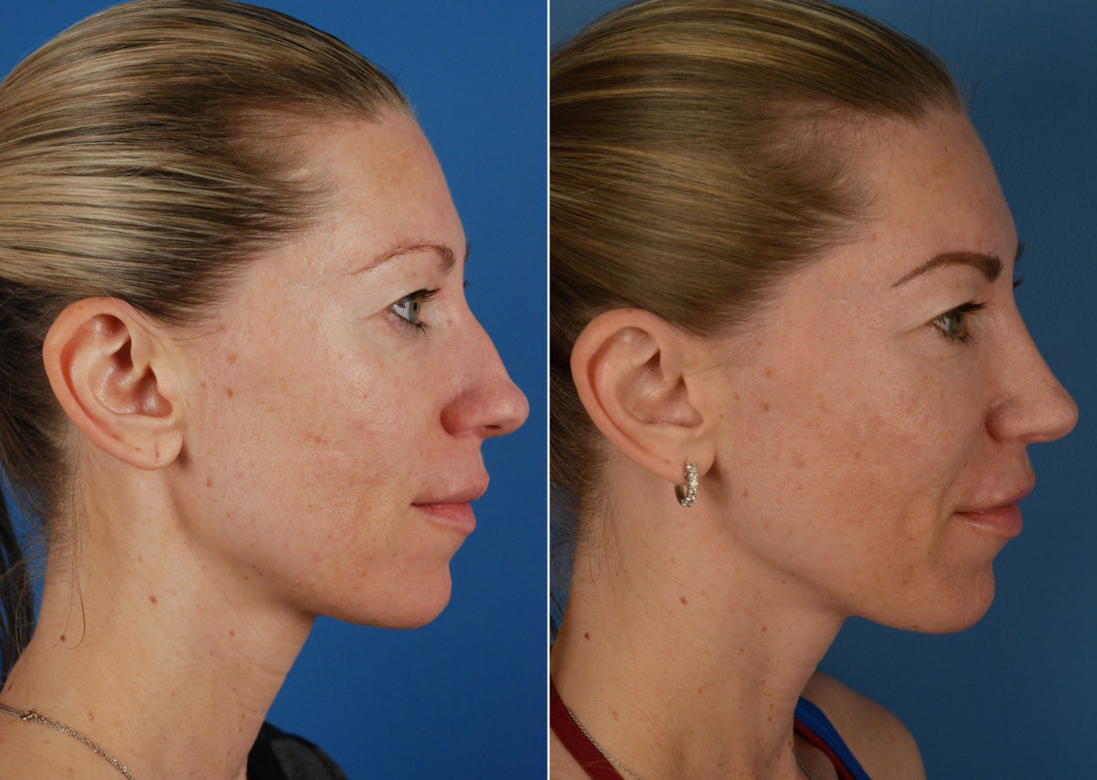 Rhinoplasty Before and After Photos in Naples, FL, Patient 11298