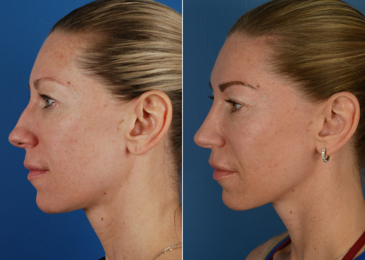 Rhinoplasty Before and After Photos in Naples, FL, Patient 11298