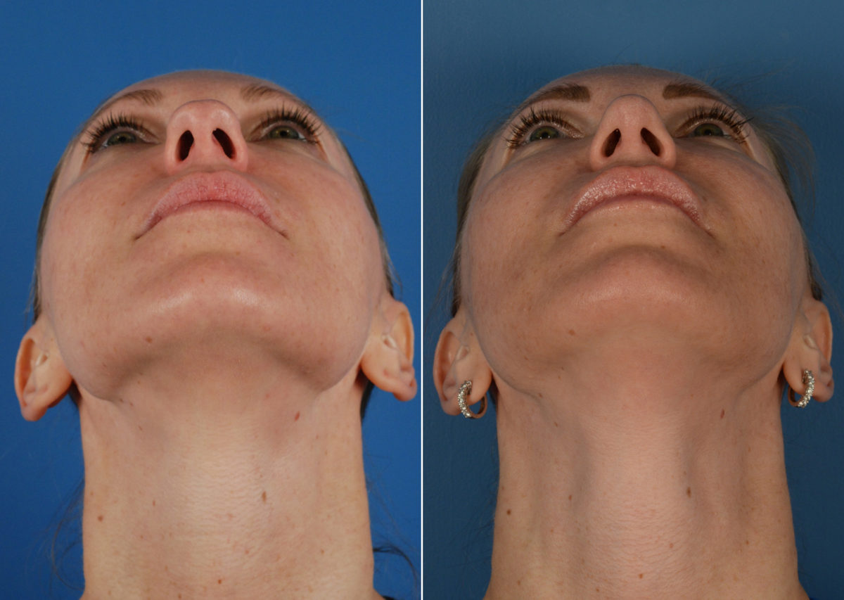 Rhinoplasty Before and After Photos in Naples, FL, Patient 11298