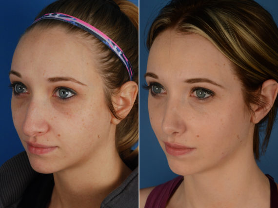 Rhinoplasty Before and After Photos in Naples, FL, Patient 11594