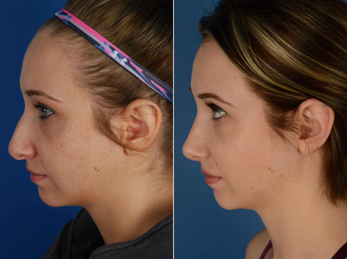 Rhinoplasty Before and After Photos in Naples, FL, Patient 11594