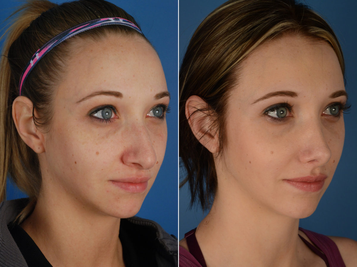 Rhinoplasty Before and After Photos in Naples, FL, Patient 11594