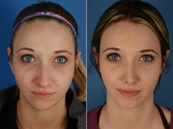 Rhinoplasty Before and After Photos in Naples, FL, Patient 11594