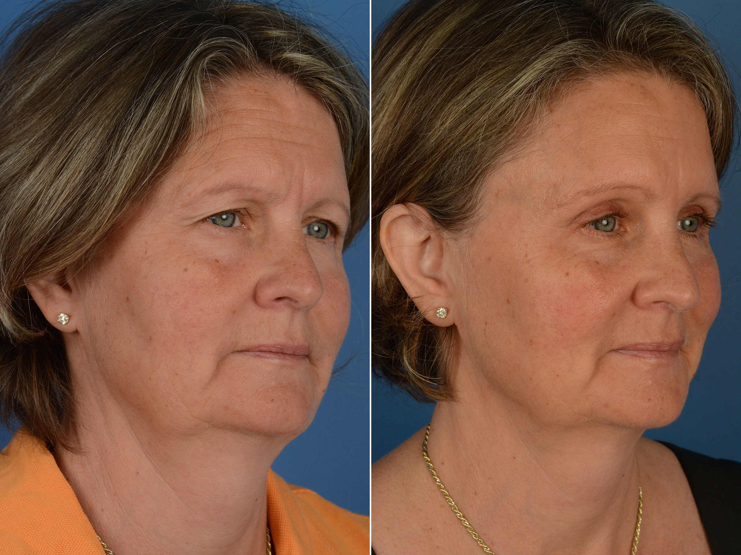 Blepharoplasty Photos Naples Fl Patient 11796