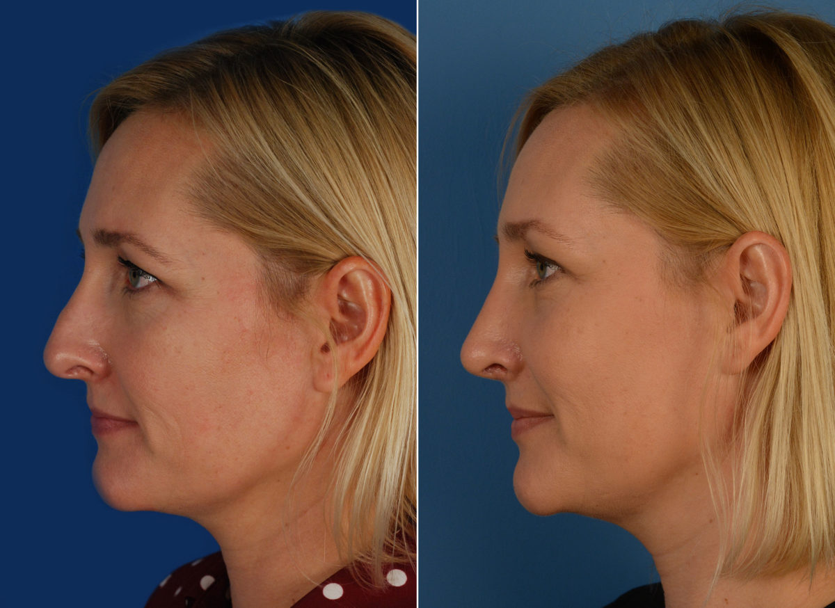 Revision Rhinoplasty Before and After Photos in Naples, FL, Patient 11827