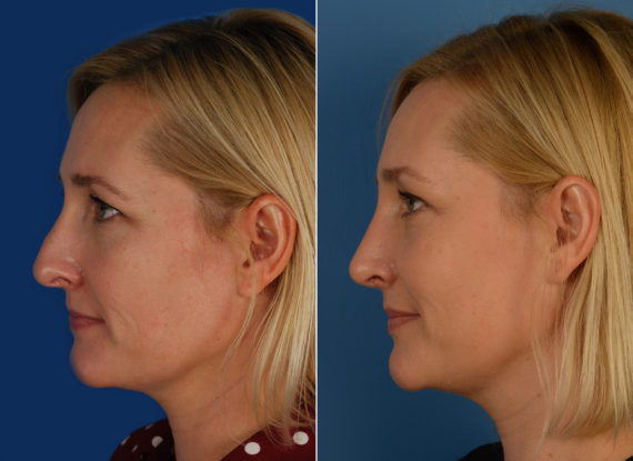 Revision Rhinoplasty Before and After Photos in Naples, FL, Patient 11827