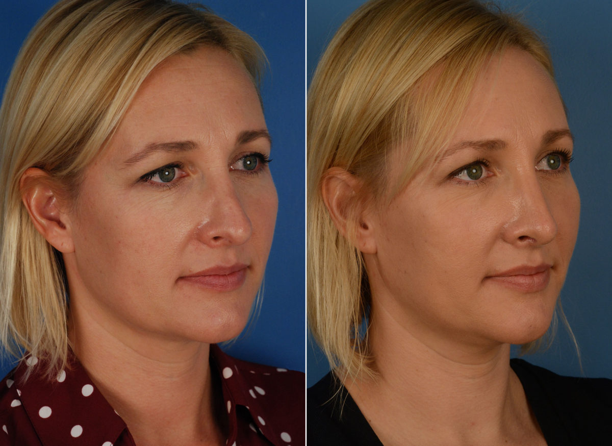 Revision Rhinoplasty Before and After Photos in Naples, FL, Patient 11827