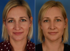 Revision Rhinoplasty Before and After Photos in Naples, FL, Patient 11827