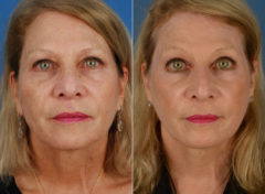 CO2 Laserwash Before and After Photos in Naples, FL, Patient 11842