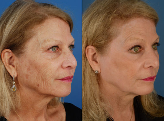 CO2 Laserwash Before and After Photos in Naples, FL, Patient 11842