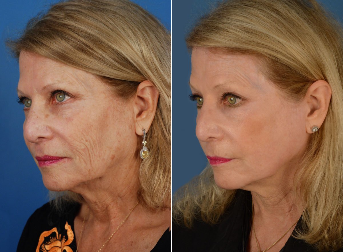 CO2 Laserwash Before and After Photos in Naples, FL, Patient 11842