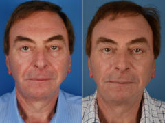 Excision of Nasolabial Folds Before and After Photos in Naples, FL, Patient 12012