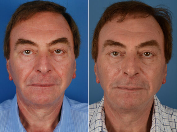Excision of Nasolabial Folds Before and After Photos in Naples, FL, Patient 12012