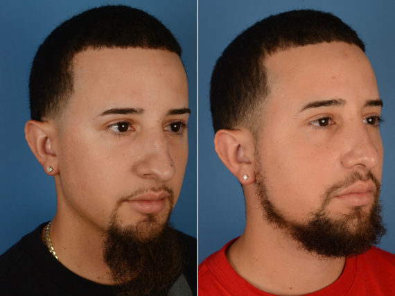 Rhinoplasty Before and After Photos in Naples, FL, Patient 12017