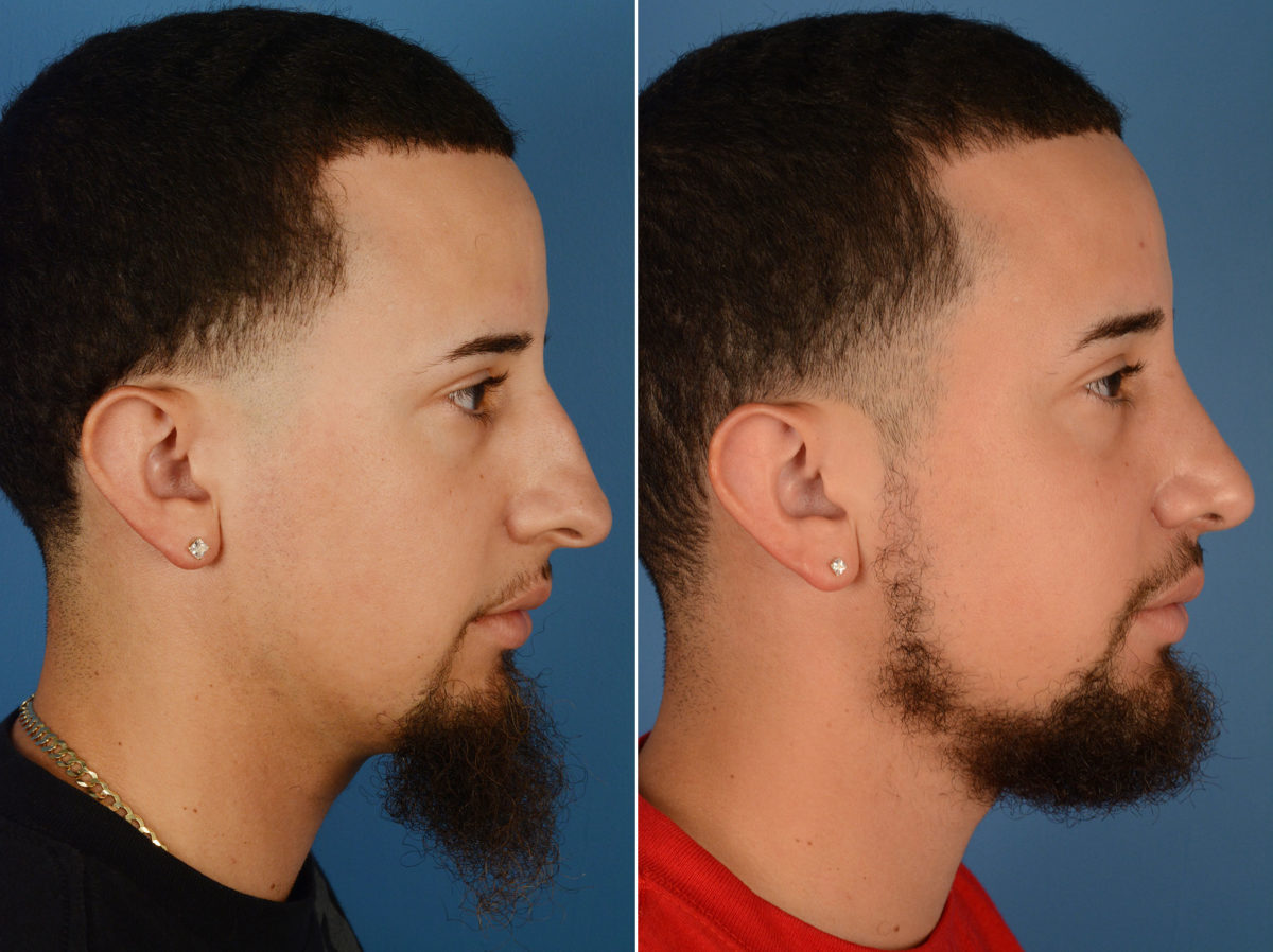 Rhinoplasty Before and After Photos in Naples, FL, Patient 12017