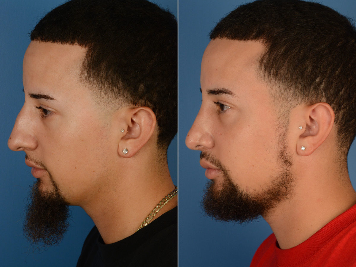 Rhinoplasty Before and After Photos in Naples, FL, Patient 12017