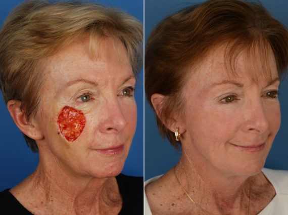 Skin Cancer Reconstruction Before and After Photos in Naples, FL, Patient 12033