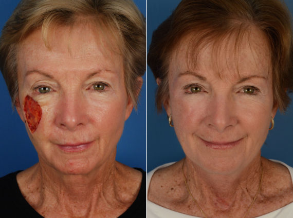 Skin Cancer Reconstruction Before and After Photos in Naples, FL, Patient 12033