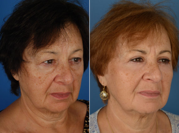 Blepharoplasty Before and After Photos in Naples, FL, Patient 12043