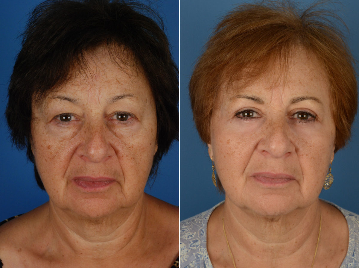 Blepharoplasty Before and After Photos in Naples, FL, Patient 12043