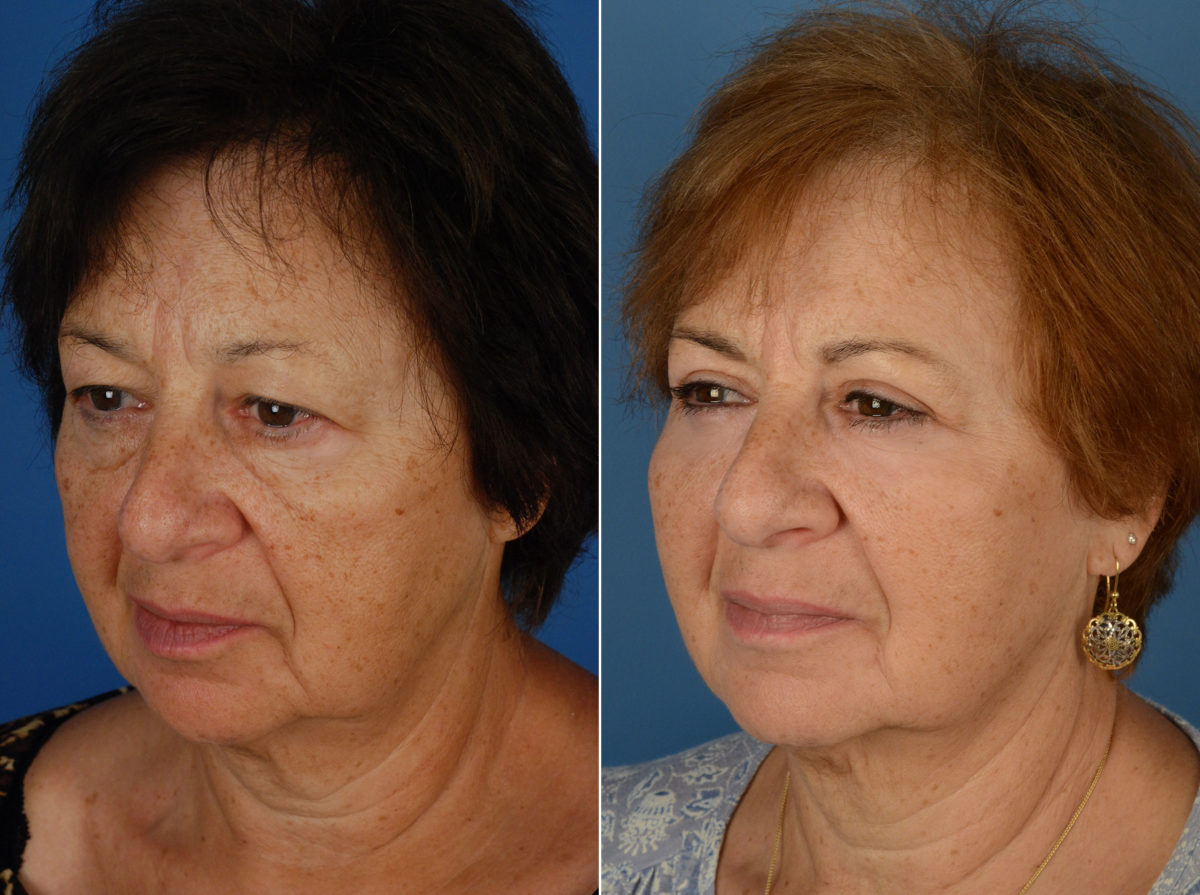 Blepharoplasty Before and After Photos in Naples, FL, Patient 12043
