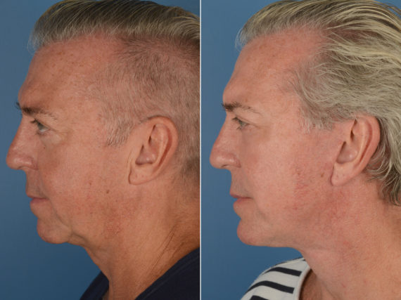 Chin Implant Before and After Photos in Naples, FL, Patient 12094