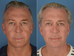 Chin Implant Before and After Photos in Naples, FL, Patient 12094