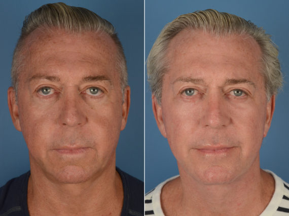 Chin Implant Before and After Photos in Naples, FL, Patient 12094