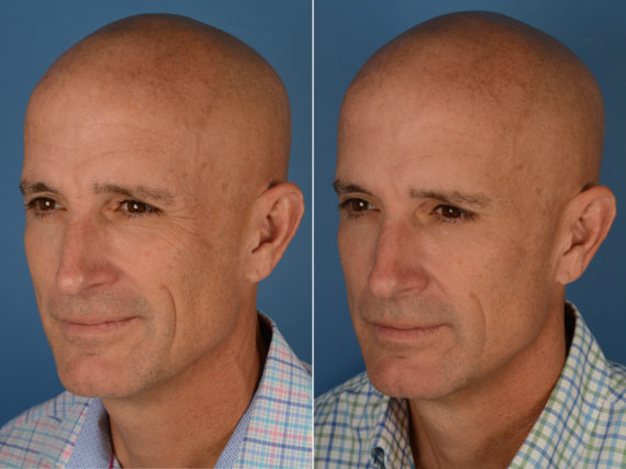 Botox Before and After Photos in Naples, FL, Patient 12223