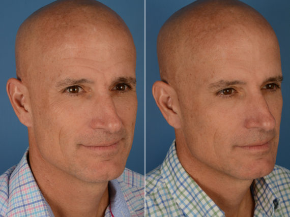 Botox Male Before and After Photos in Naples, FL, Patient 12223