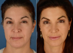 Revision Rhinoplasty Before and After Photos in Naples, FL, Patient 12593